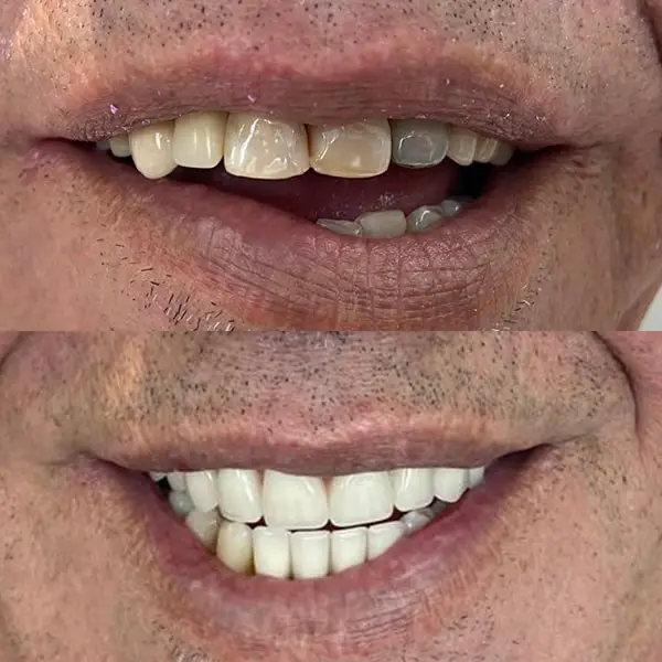 antes de depois implante protese