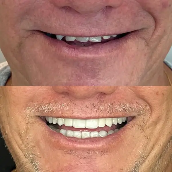 antes de depois implante protese