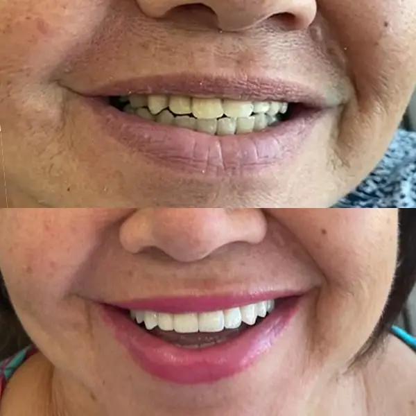 antes de depois implante protese