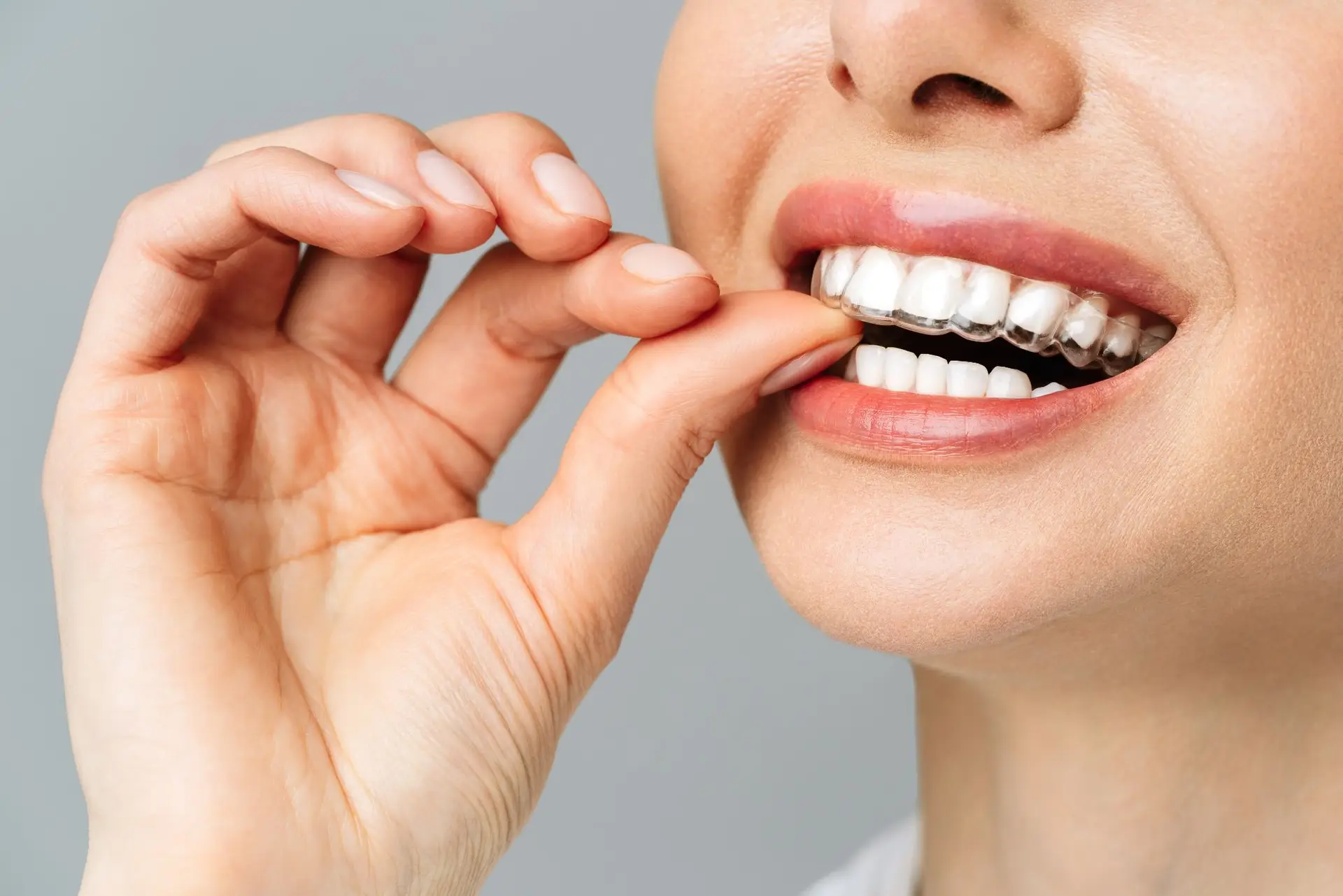 Invisalign Alinhamento Dental