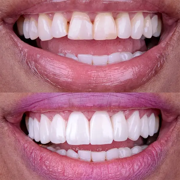 antes-depois-facetas-01